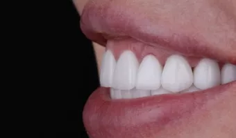 Реставрация улыбки винирами: кому подходит, плюсы и минусы