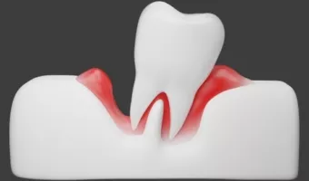 Все про видалення пародонтозних зубів