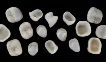 Виды зубных коронок: на что обратить внимание при выборе?