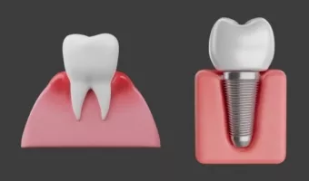 Имплантация зубов при пародонтозе