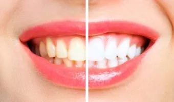 Чистка и отбеливание зубов: что выбрать?