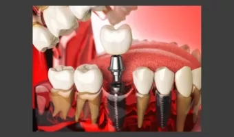 Базальная имплантация зубов: за и против