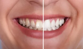 Виды профессиональной чистки зубов в стоматологии