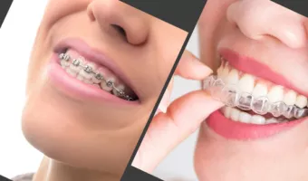 Цены брекетов на элайнеров в 2024 году