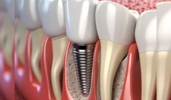 Долговечность имплантатов: что влияет на срок службы и как его продлить