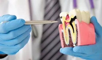 Нужно ли лечить кариес, если зуб не болит?