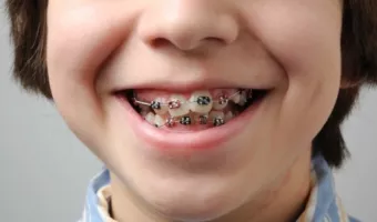 С какого возраста начинать ортодонтическое лечение зубов ребенку?