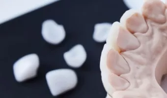 Сравнение виниров, коронок, протезов и накладок для восстановления зубов