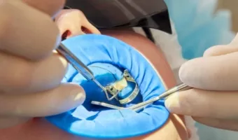 Коффердам в стоматологии: важный инструмент или лишняя роскошь?