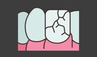Реставрация зубов после травм: как вернуть улыбке красоту?