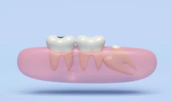 Непрорізані зуби мудрості: діагностика та видалення