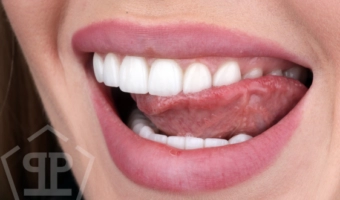 Виниры от А до Я: комплексный обзор