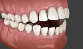 Лечение открытого прикуса: как исправить проблему без осложнений