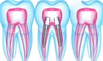 Відновлення зуба штифтом: показання і переваги
