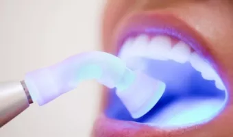 Рекомендації після установки фотополімерної пломби