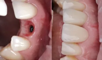 Найкращі зубні імпланти: огляд і фото