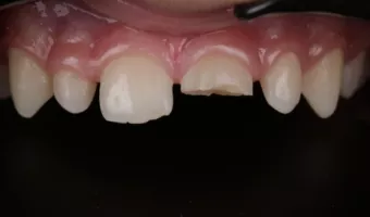 Відкол зуба у дитини: первинна допомога та лікування