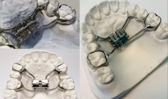 Виправлення прикусу апаратом Дерихсвайлера