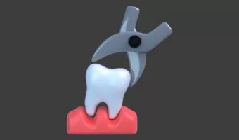 Видалення молочних зубів в стоматології