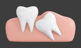 Зубы мудрости: удалять или оставлять?