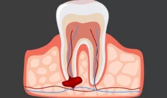 Видалення кісти на корені зуба