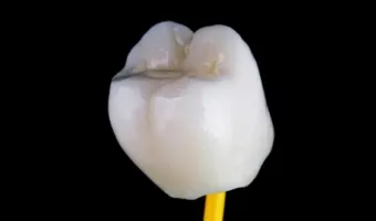 Протезирование – современные методы восстановления зубов