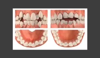 Скученность зубов: причины, лечение у детей и взрослых