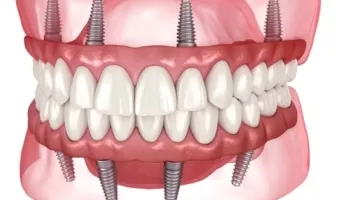 Революція в стоматології: чи здатні імпланти повністю замінити зуби?