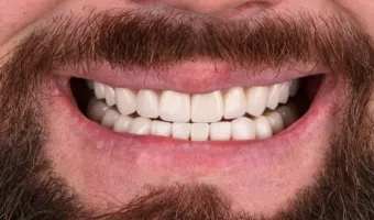 Уход за зубами после отбеливания, установки виниров и коронок