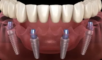 Протезування на імплантах All-on-4 та All-on-6: різниця, плюси й мінуси