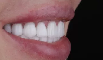 Вініри чи відбілювання зубів: як зробити правильний вибір?