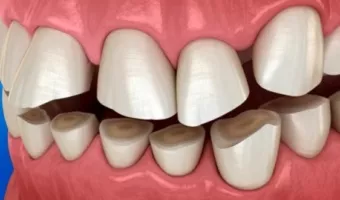 Бруксизм: причини, симптоми, лікування скреготу зубами