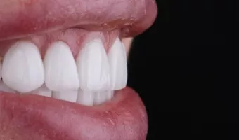 ТОП 10 мифов про керамические виниры