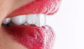 Виниры CEREC – короткий путь к идеальной улыбке
