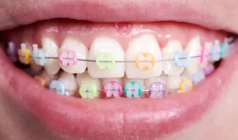 Металлические или керамические брекеты: какие выбрать для подростка?