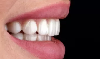 ТОП 10 міфів про керамічні вініри