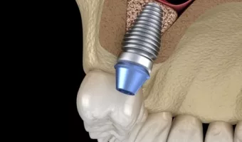 Рекомендації після синус-ліфтингу від імплантолога