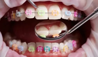 Виправлення асиметрії обличчя вирівнюванням зубів