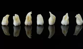 Видалення премолярів в ортодонтії