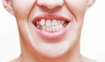 Перехресний прикус – ознаки та лікування