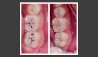 Фісурний карієс – лікування у дорослих та дітей