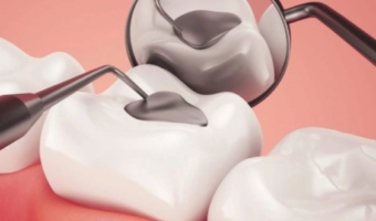 Временные пломбы – назначение и уход