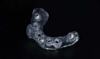 Хірургічний шаблон для імплантації – застосування і переваги