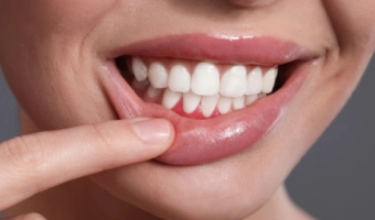 Чистка зубов при больных деснах – как не навредить?